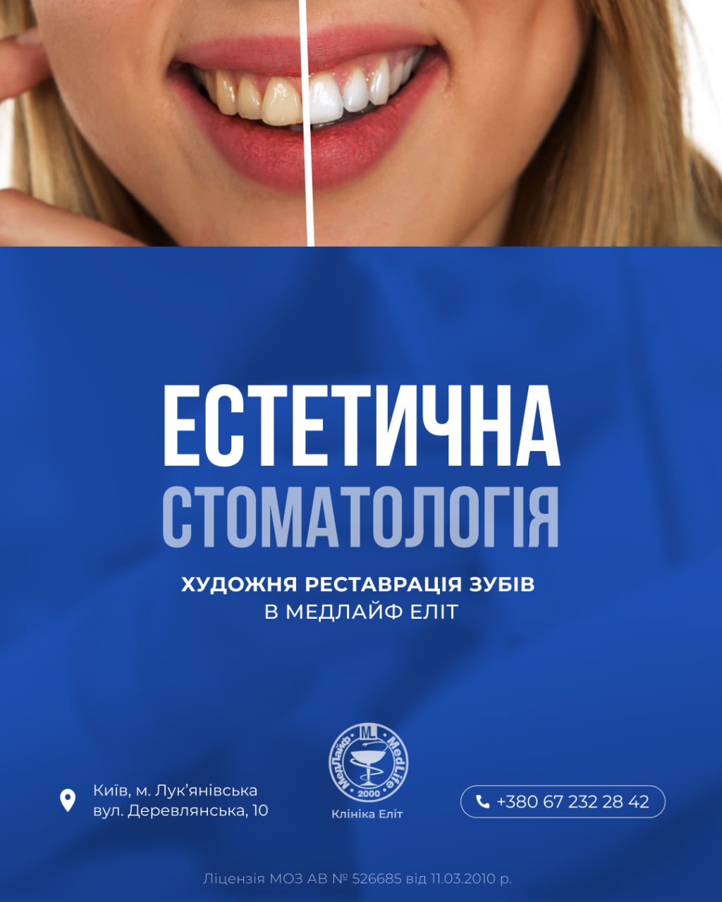 Естетична стоматологія. Художня реставрація зубів у «МедЛайф Еліт»